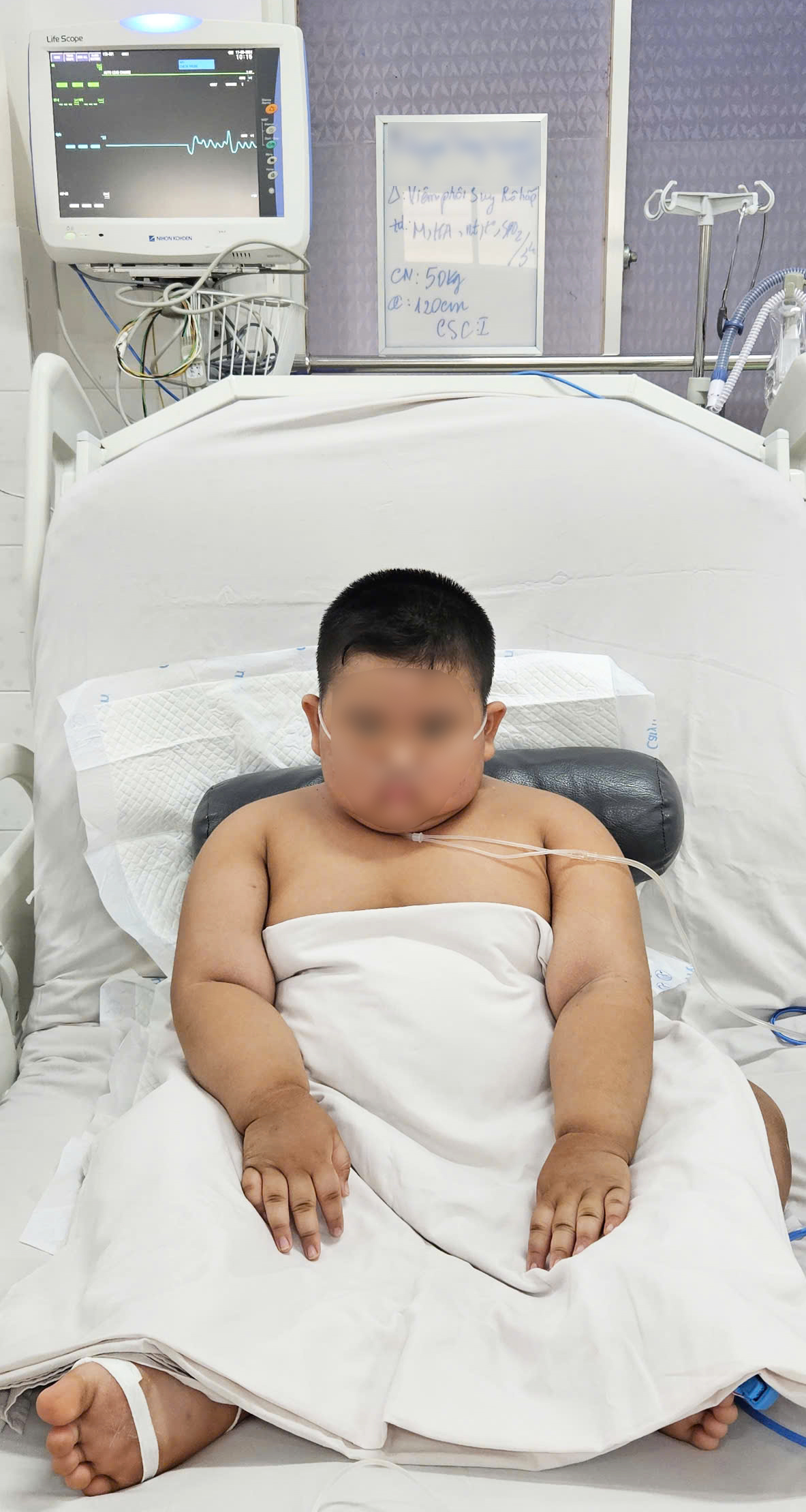 CỨU SỐNG MỘT TRƯỜNG HỢP TRẺ BÉO PHÌ NẶNG MẮC CÚM A/H1 BỘI NHIỄM DIỄN TIẾN SỐC NHIỄM TRÙNG KÈM HỘI CHỨNG SUY HÔ HẤP CẤP TIẾN TRIỂN (ARDS) CÓ NGUY CƠ TỬ VONG