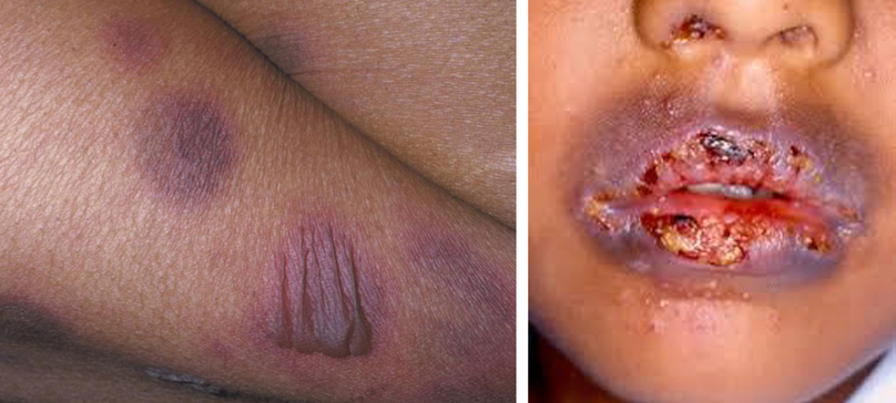 HỒNG BAN CỐ ĐỊNH NHIỄM SẮC (FIXED DRUG ERUPTION)