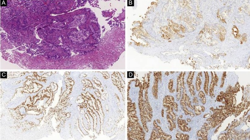 UNG THƯ TẠNG ĐẶC DI CĂN DA (CUTANEOUS METASTASES OF SOLID TUMORS)