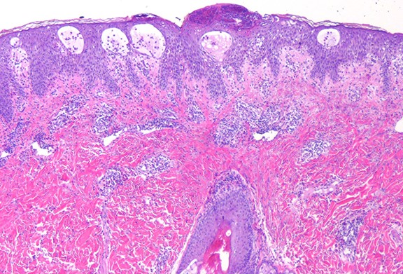 PHÁT BAN MỤN MỦ TOÀN THÂN CẤP TÍNH (ACUTE GENERALISED EXANTHEMATOUS PUSTULOSIS)