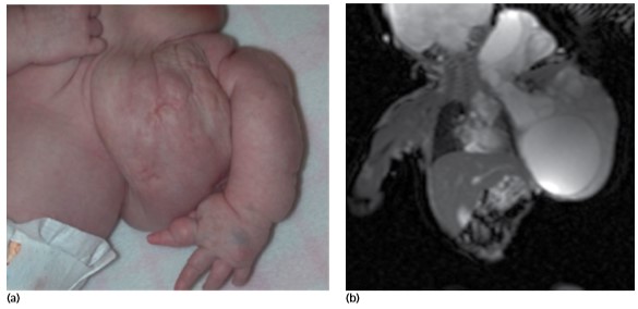 U BẠCH HUYẾT (LYMPHANGIOMA)