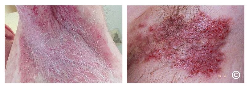 BỆNH HAILEY – HAILEY (PEMPHIGUS LÀNH TÍNH CÓ TÍNH CHẤT DA ĐÌNH)