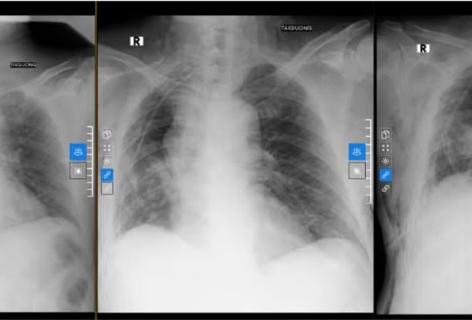 RÒ KHÍ KÉO DÀI SAU PHẪU THUẬT NỘI SOI CẮT THÙY PHỔI