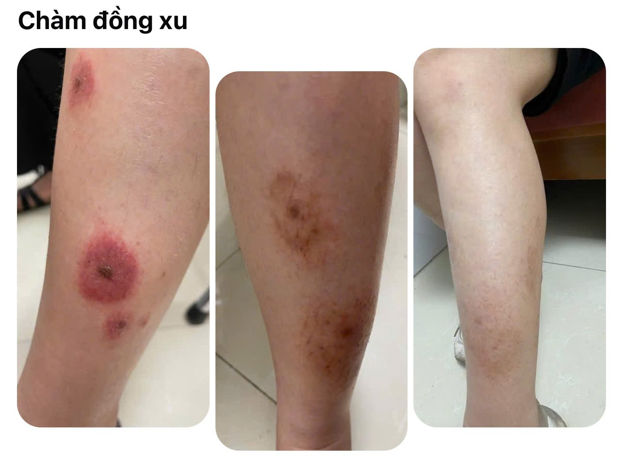 Chàm đồng tiền (Nummular Eczema)