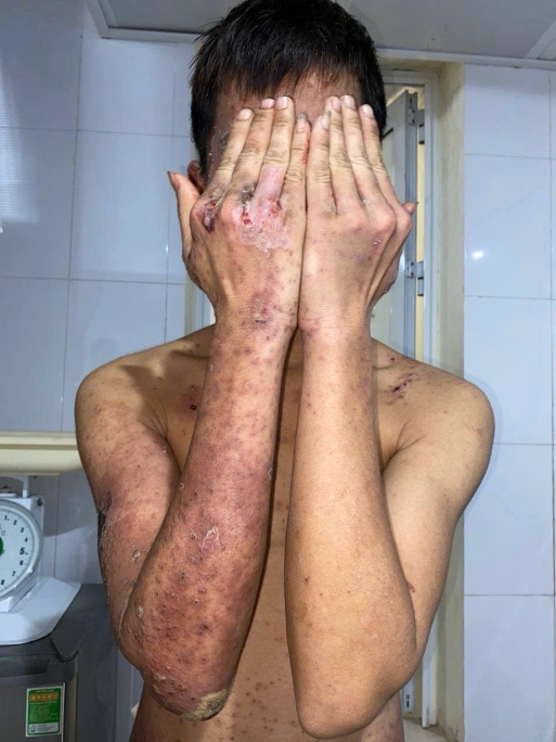 Thanh niên tổn thương da toàn thân, chảy dịch do đắp kiến ba khoang chữa ngứa