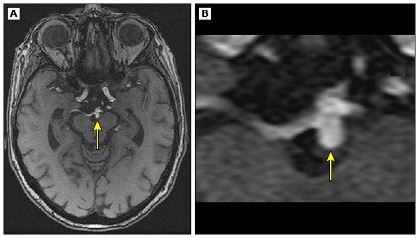 Phình động mạch não chưa vỡ – Khi nào cần điều trị?