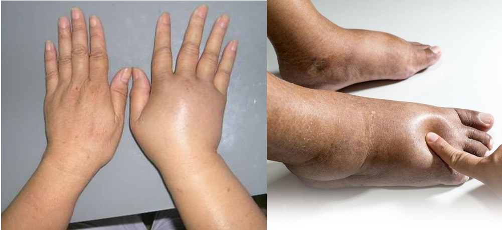 Phù tay chân hay phù toàn thân là dấu hiệu của bệnh lý gì?
