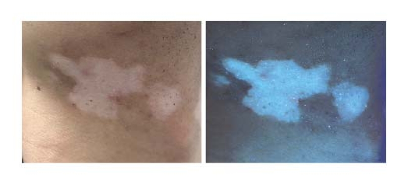 Dấu hiệu nhận biết phân biệt bệnh Bạch biến với một số bệnh da giảm sắc tố khác