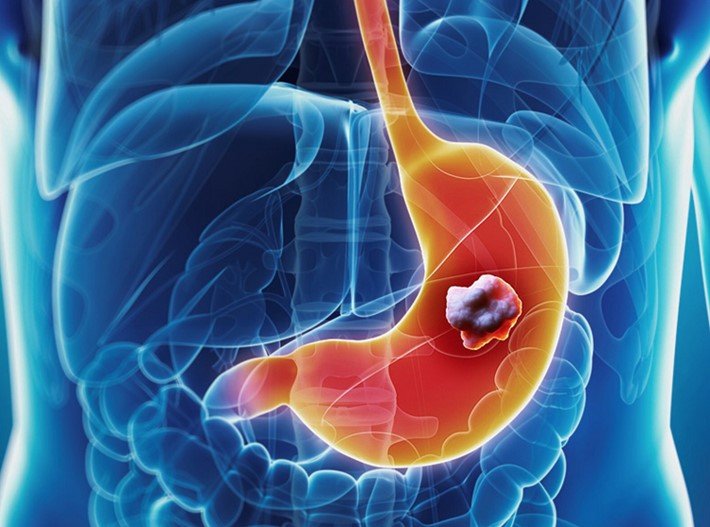 Ung thư dạ dày : Chẩn đoán, điều trị và các biện pháp phòng ngừa