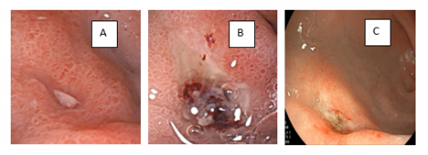 Xuất huyết tiêu hóa do viêm loét dạ dày tá tràng ở trẻ em
