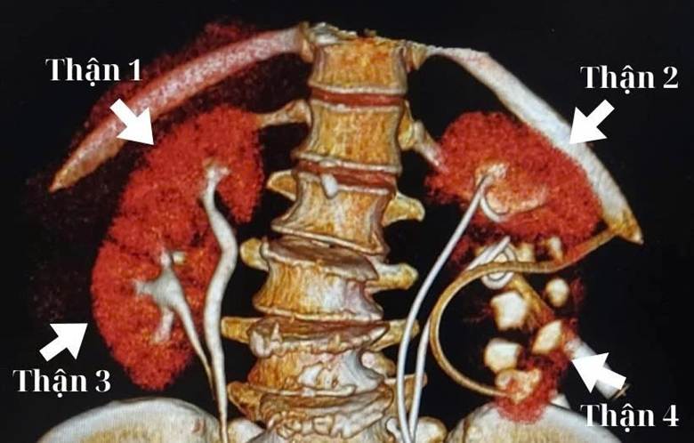 Người phụ nữ 65 tuổi mang 4 quả thận được can thiệp kịp thời      |