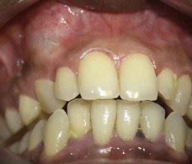 Nang xương hàm: Những thông tin cần biết