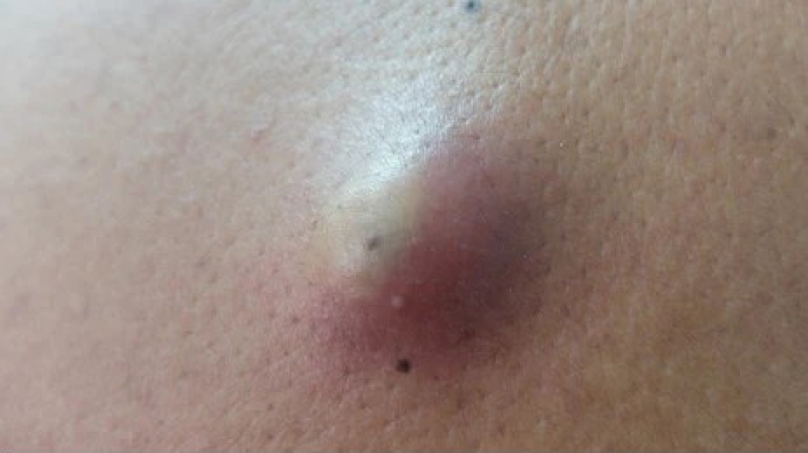 Kén thượng bì (Epidermoid cyst)