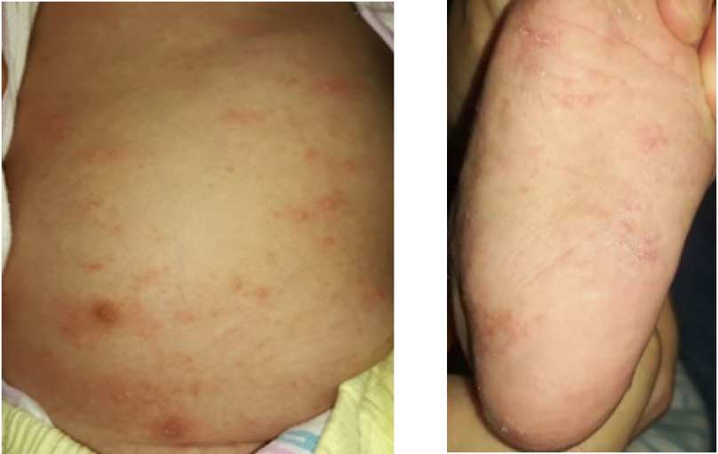 Bệnh ghẻ ở trẻ em