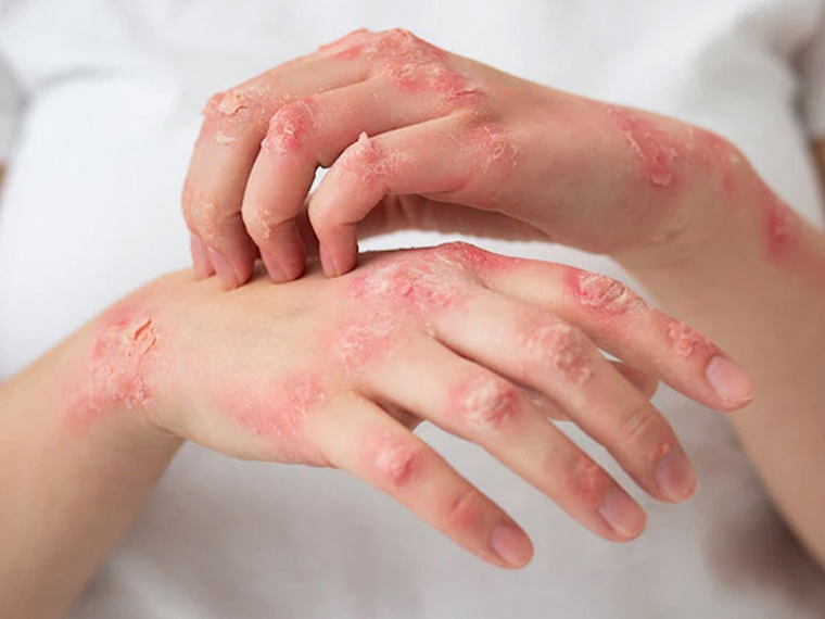 Giáo dục sức khỏe cho người bệnh viêm da cơ địa