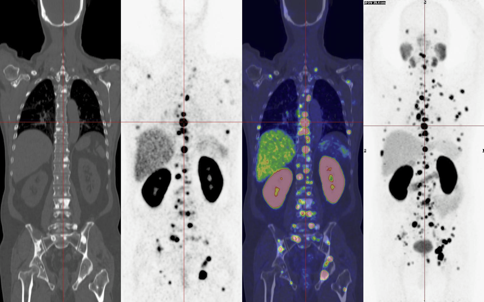 68Ga-PSMA PET/CT: Bước tiến đột phá trong chẩn đoán và điều trị ung thư tuyến tiền liệt
