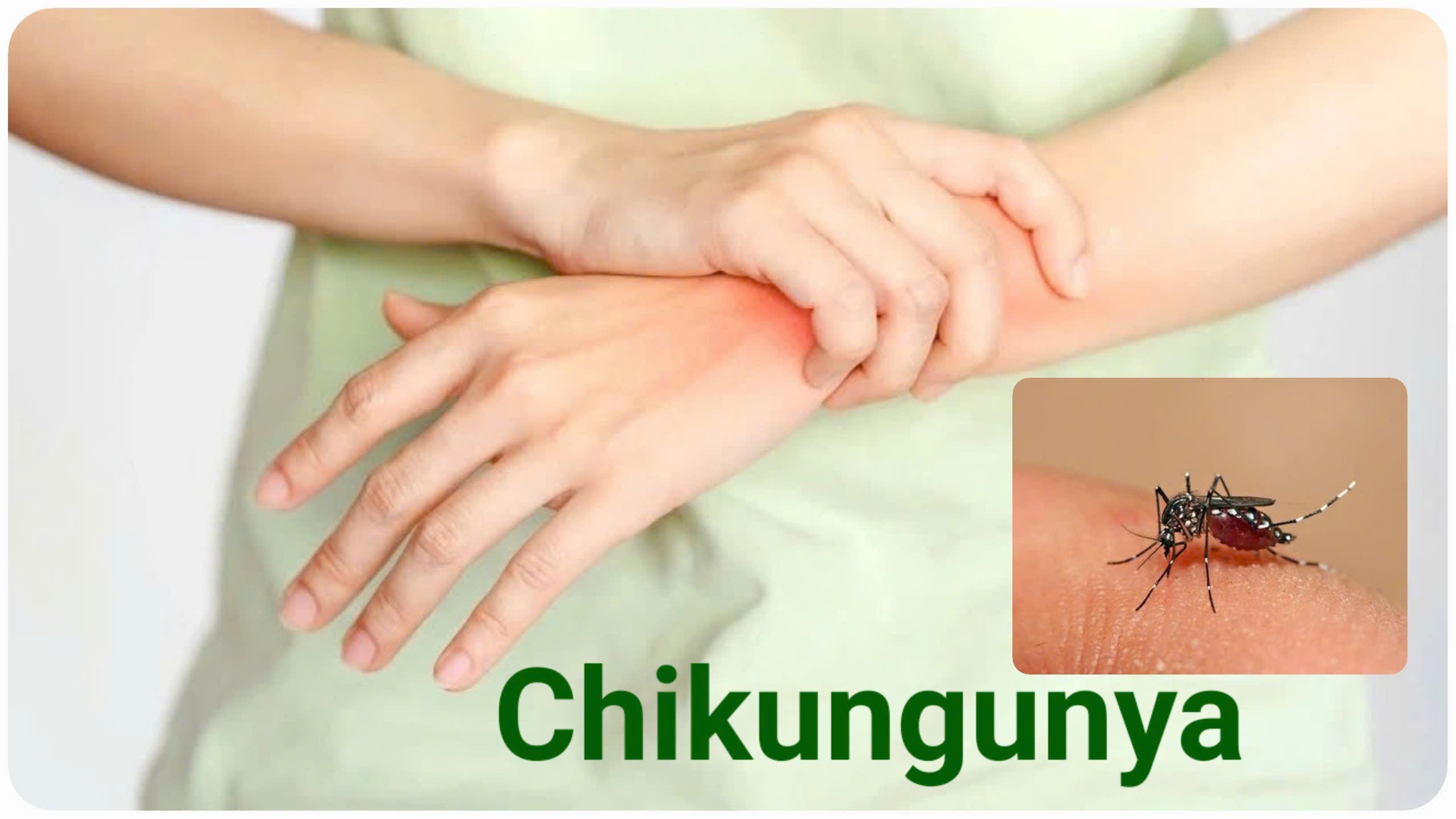 Chikungunya – Bệnh truyền nhiễm đang diễn biến phức tạp, nguy cơ xâm nhập vào Việt Nam