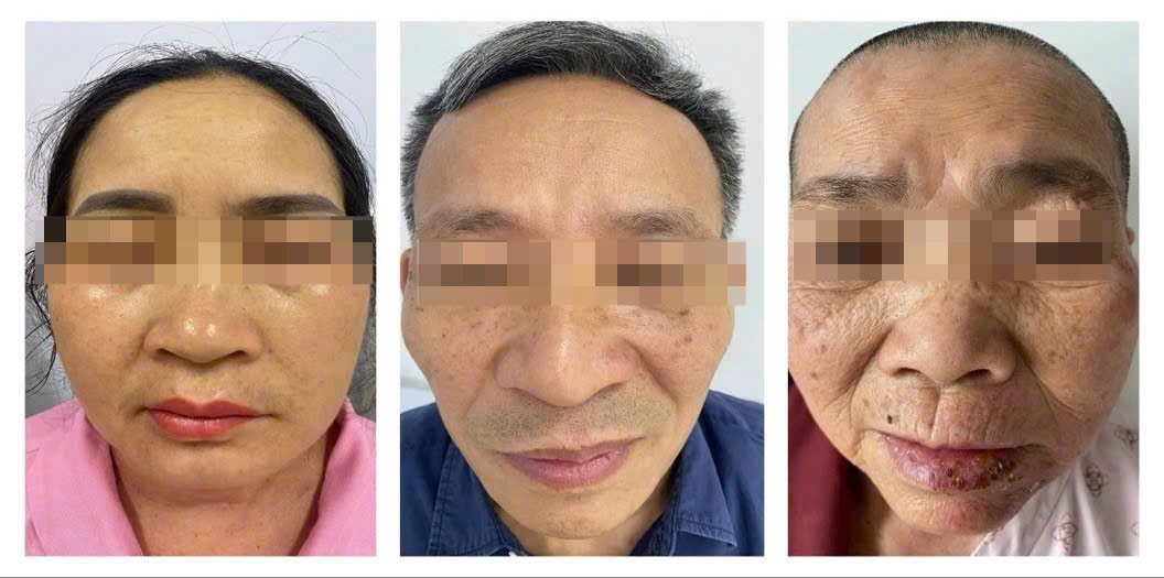 Liệt mặt do zona – hiểm hoạ khôn lường