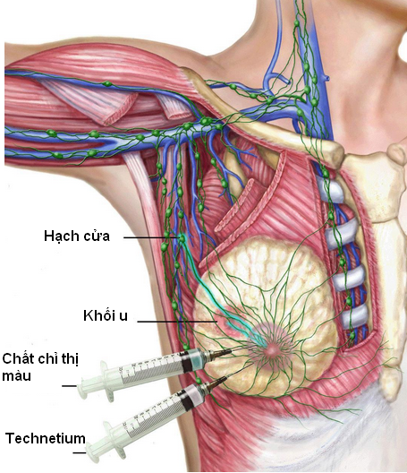 SINH THIẾT HẠCH CỬA BẰNG XANH INDOCYANINE (ICG) – KỸ THUẬT MỚI ĐƯỢC BỆNH VIỆN K ÁP DỤNG GÓP PHẦN CAN THIỆP TỐI THIỂU CHO NGƯỜI BỆNH UNG THƯ VÚ GIAI ĐOẠN SỚM