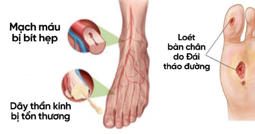 NGUY CƠ CẮT CỤT CHI DO BỆNH LÝ BÀN CHÂN ĐÁI THÁO ĐƯỜNG