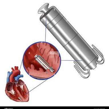 CÁC CÔNG NGHỆ TIÊN TIẾN ĐƯỢC ỨNG DỤNG TRONG ĐIỀU TRỊ RỐI LOẠN NHỊP TIM HIỆN NAY
