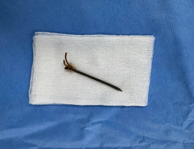 Cứu sống bệnh nhân bị đinh xuyên khí quản, tổn thương mạch máu lớn nguy kịch