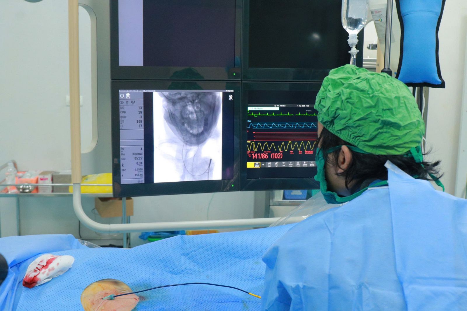 Triển khai kỹ thuật mới – cấp cứu thành công bệnh nhân 80 tuổi bị hôn mê, liệt nửa người