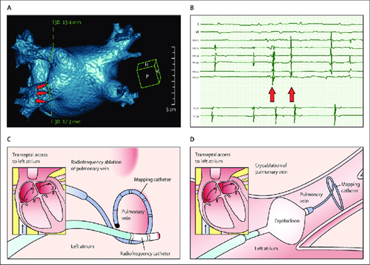 CÁC CÔNG NGHỆ TIÊN TIẾN ĐƯỢC ỨNG DỤNG TRONG ĐIỀU TRỊ RỐI LOẠN NHỊP TIM HIỆN NAY