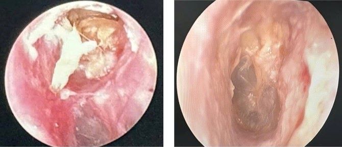 Ứng dụng phẫu thuật nội soi tai dưới nước, mở ra cơ hội điều trị an toàn và hiệu quả cho người bệnh