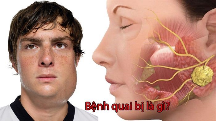 Quai bị: Bài học từ ca bệnh và khuyến cáo của bác sĩ