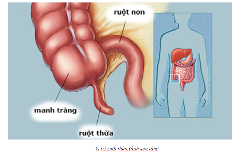 VIÊM RUỘT THỪA Ở TRẺ EM: NGUYỄN NHÂN, TRIỆU CHỨNG VÀ CÁCH XỬ TRÍ.