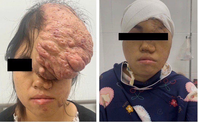 Sở Y tế TP.HCM: Bệnh viện đa khoa Bình dương phẫu thuật thành công khối u sụn xương sọ có kích thước khổng lồ