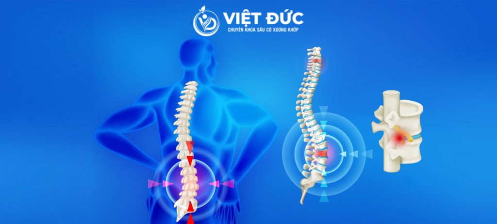 Thoát vị đĩa đệm nhân nhầy gây hẹp ống sống