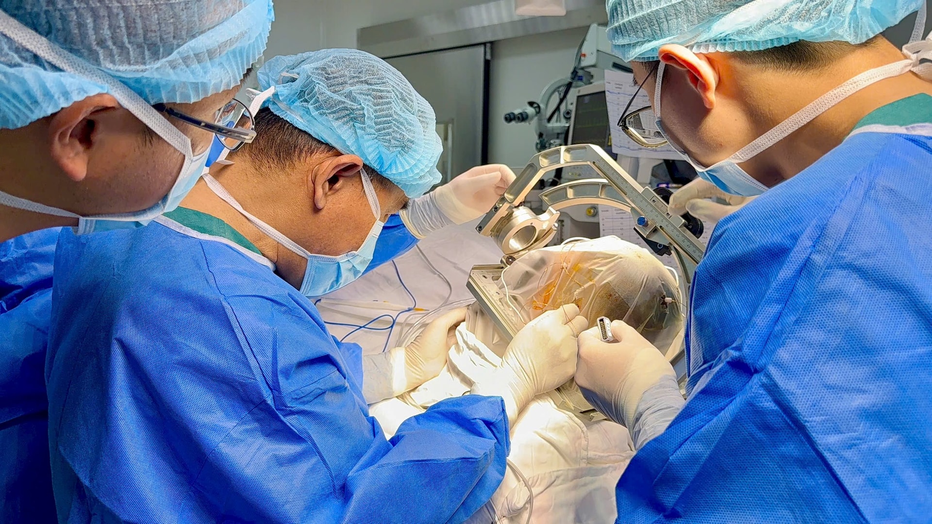 Ca SEEG đầu tiên tại Bệnh viện Nguyễn Tri Phương: Bước tiến mới trong điều trị động kinh