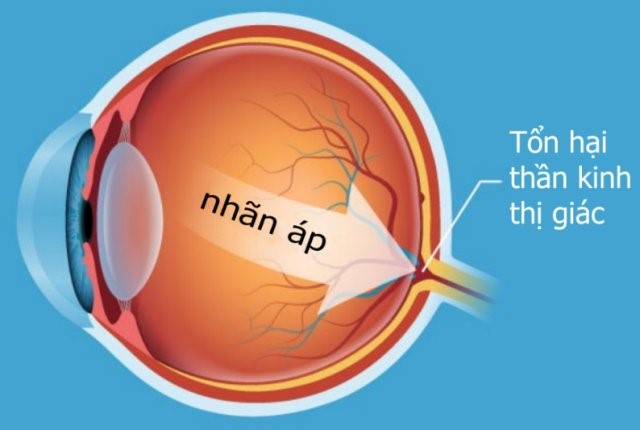 Tăng nhãn áp có đồng nghĩa với bị glôcôm?