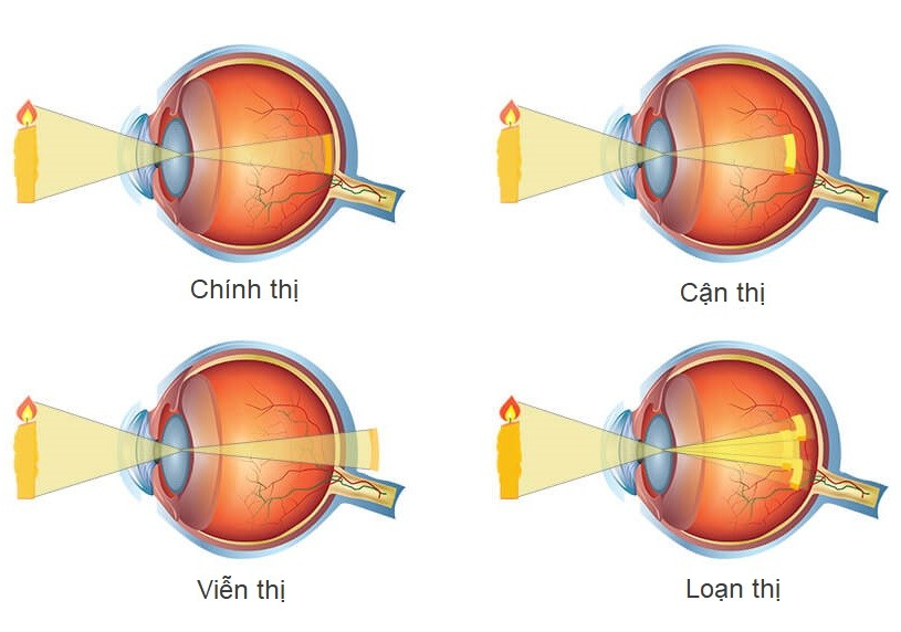 Tật khúc xạ học đường – Cần phòng, chống và kiểm soát sớm