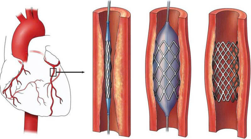 CAN THIỆP ĐỘNG MẠCH VÀNH QUA DA (PCI): ƯU ĐIỂM, CHỈ ĐỊNH VÀ QUY TRÌNH