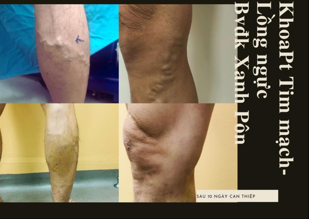 PHƯƠNG PHÁP CẢI THIỆN TRIỆU CHỨNG BỆNH SUY GIÃN TĨNH MẠCH TRONG MÙA HÈ