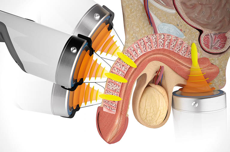 Cải thiện rối loạn cương dương nhờ sóng xung kích: Giải pháp không xâm lấn, hiệu quả lâu dài