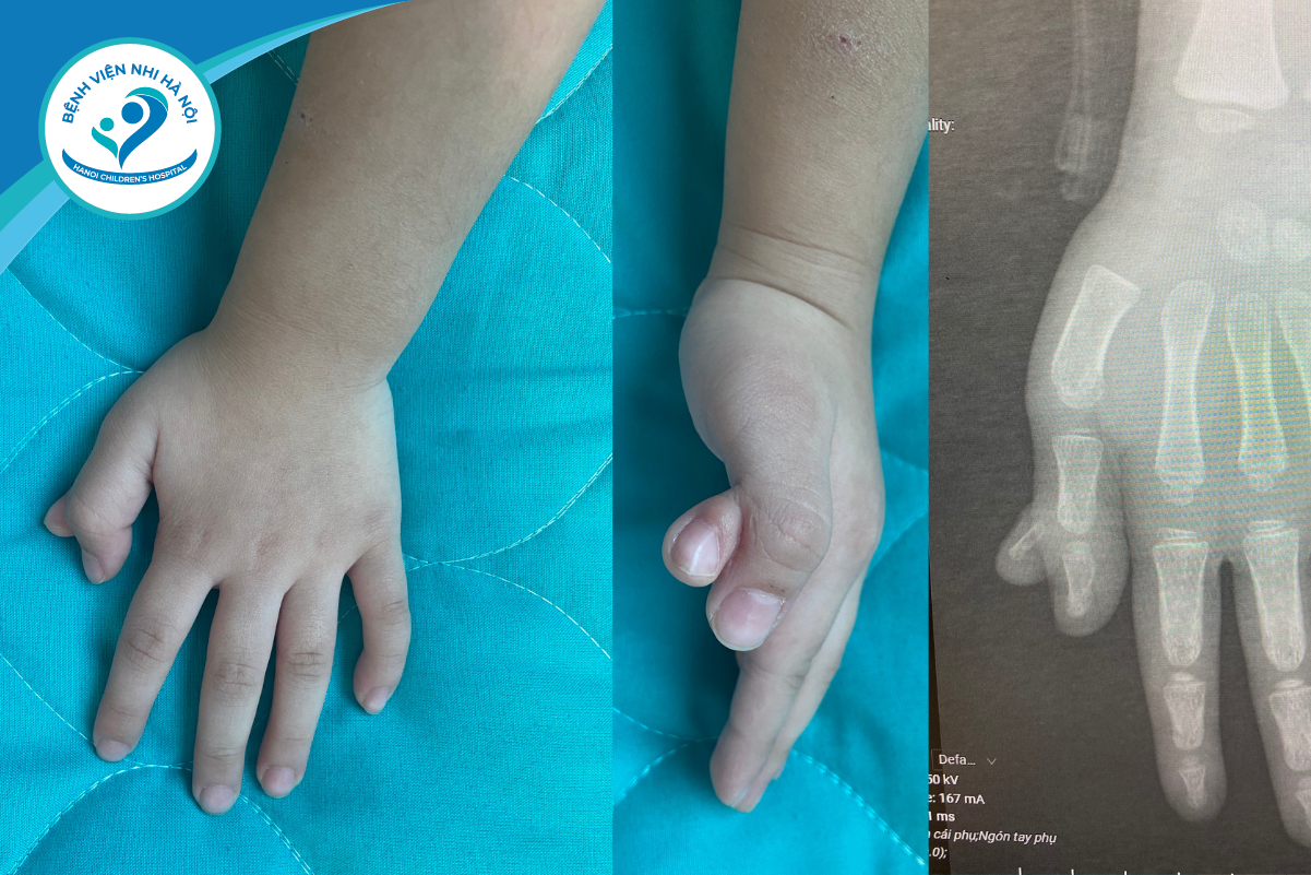 Thừa Ngón Tay Bẩm Sinh: Nguyên Nhân, Biểu Hiện và Phương Pháp Điều Trị Toàn Diện