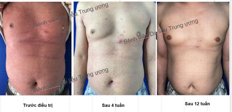 Điều trị bệnh Vảy nến bằng thuốc sinh học: Những điều cần biết