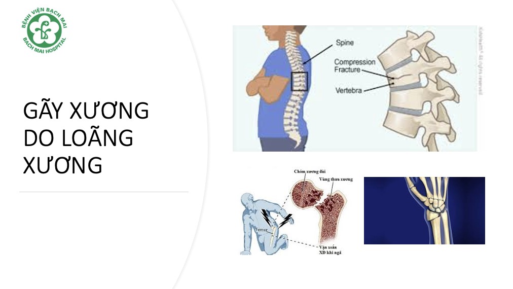 Loãng xương – căn bệnh tiến triển âm thầm, hậu quả nặng nề