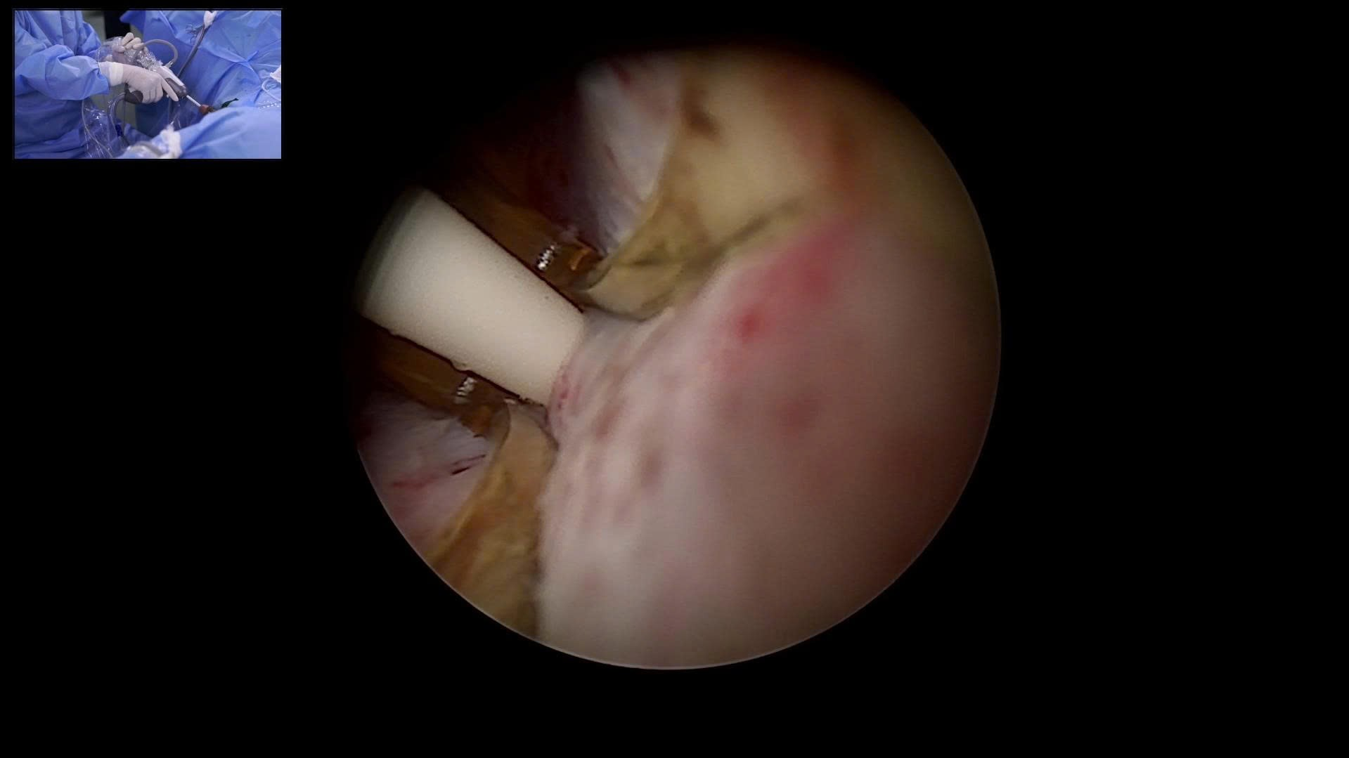 Bệnh viện Bạch Mai tiên phong ứng dụng công nghệ Rezūm – bước tiến mới trong điều trị u phì đại tuyến tiền liệt