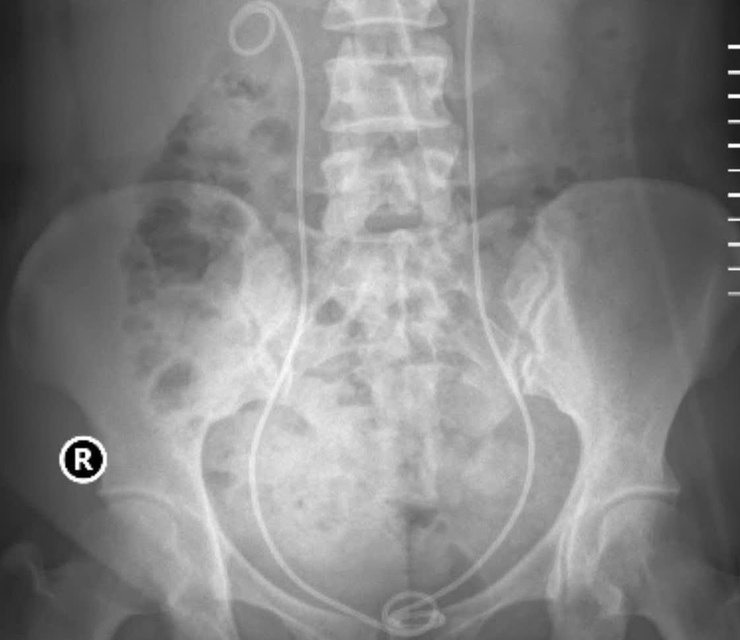 Bệnh viện Thận Hà Nội phối hợp linh hoạt các kỹ thuật tán sỏi hiện đại trong điều trị