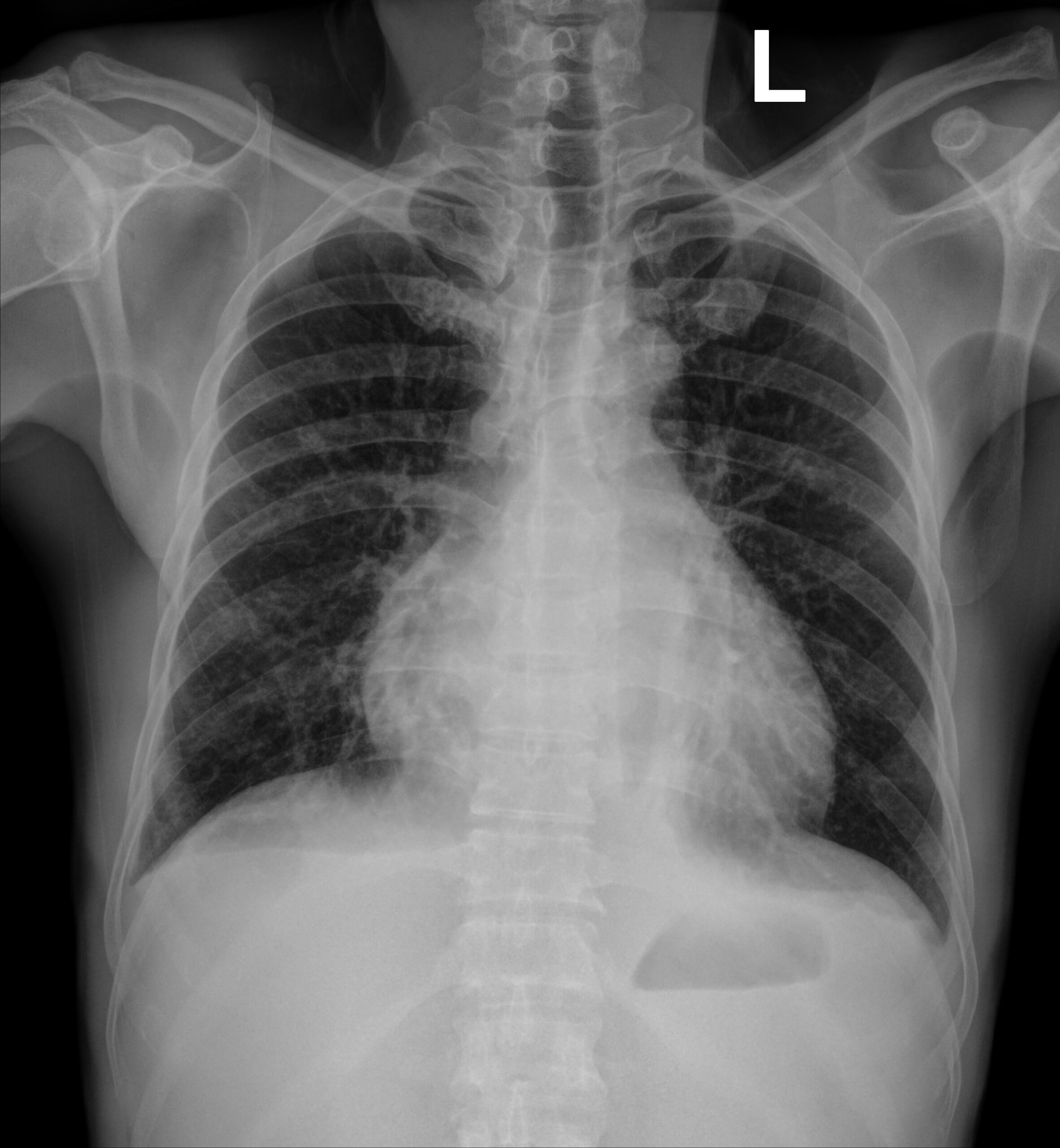 Tổn thương phổi – nguyên nhân hàng đầu gây tử vong liên quan tới truyền máu