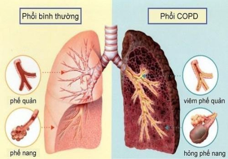 BÀI TUYÊN TRUYỀN BỆNH PHỔI TẮC NGHẼN MÃN TÍNH