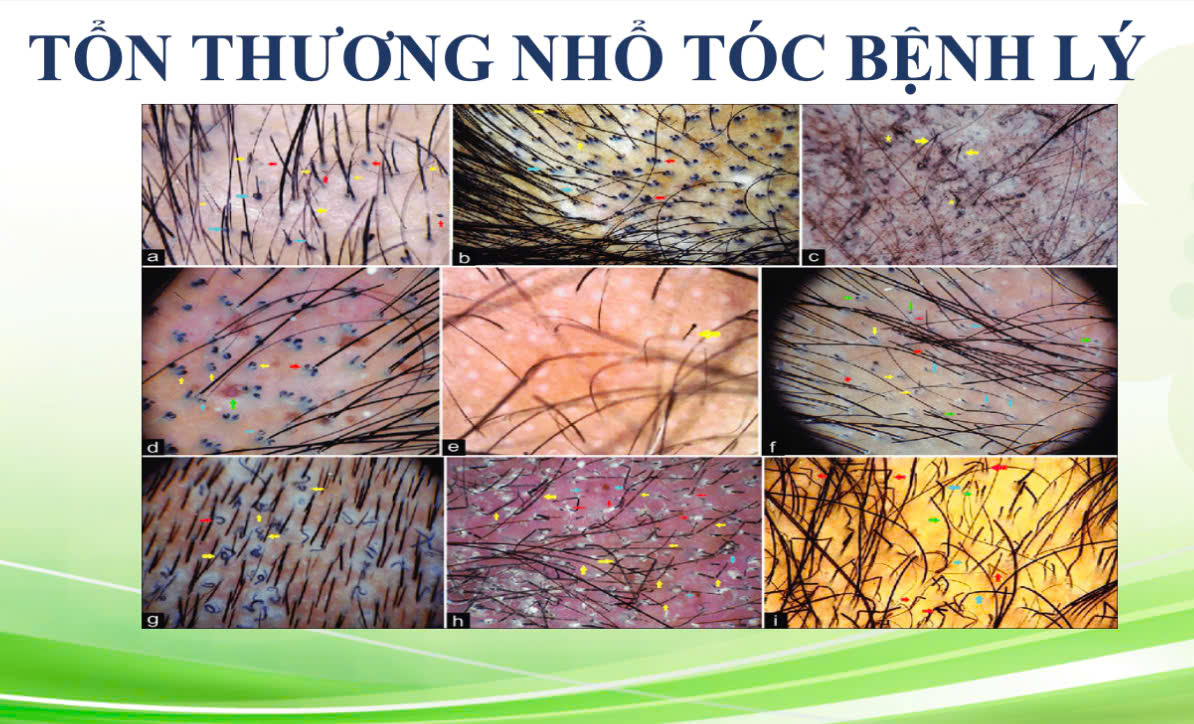 Nhổ tóc bệnh lý: Không phải thói quen xấu, mà là một rối loạn tâm thần cần được chữa trị
