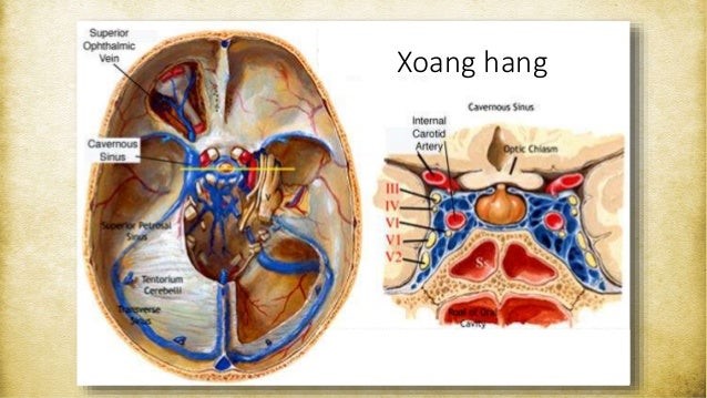 “Tử thần” mang tên viêm tắc tĩnh mạch xoang hang: Dấu hiệu không nên bỏ qua