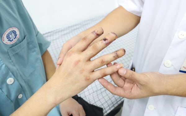 Ứng dụng kỹ thuật vạt da bụng có cuống, phục hồi bàn tay cho người bệnh bị tổn thương nặng