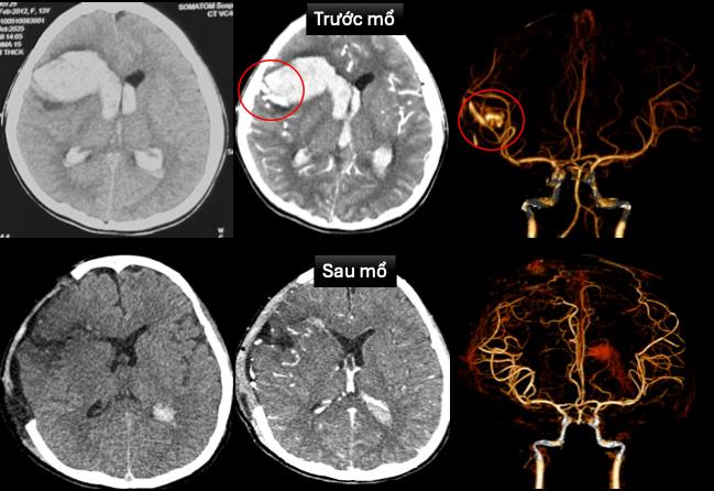 Cứu sống bệnh nhi hôn mê do vỡ dị dạng mạch máu não trên nền bệnh cơ tim hiếm gặp